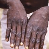 Les mains d'une personne infectée par le virus du mpox en RDC (archives). KEYSTONE/AP CDC